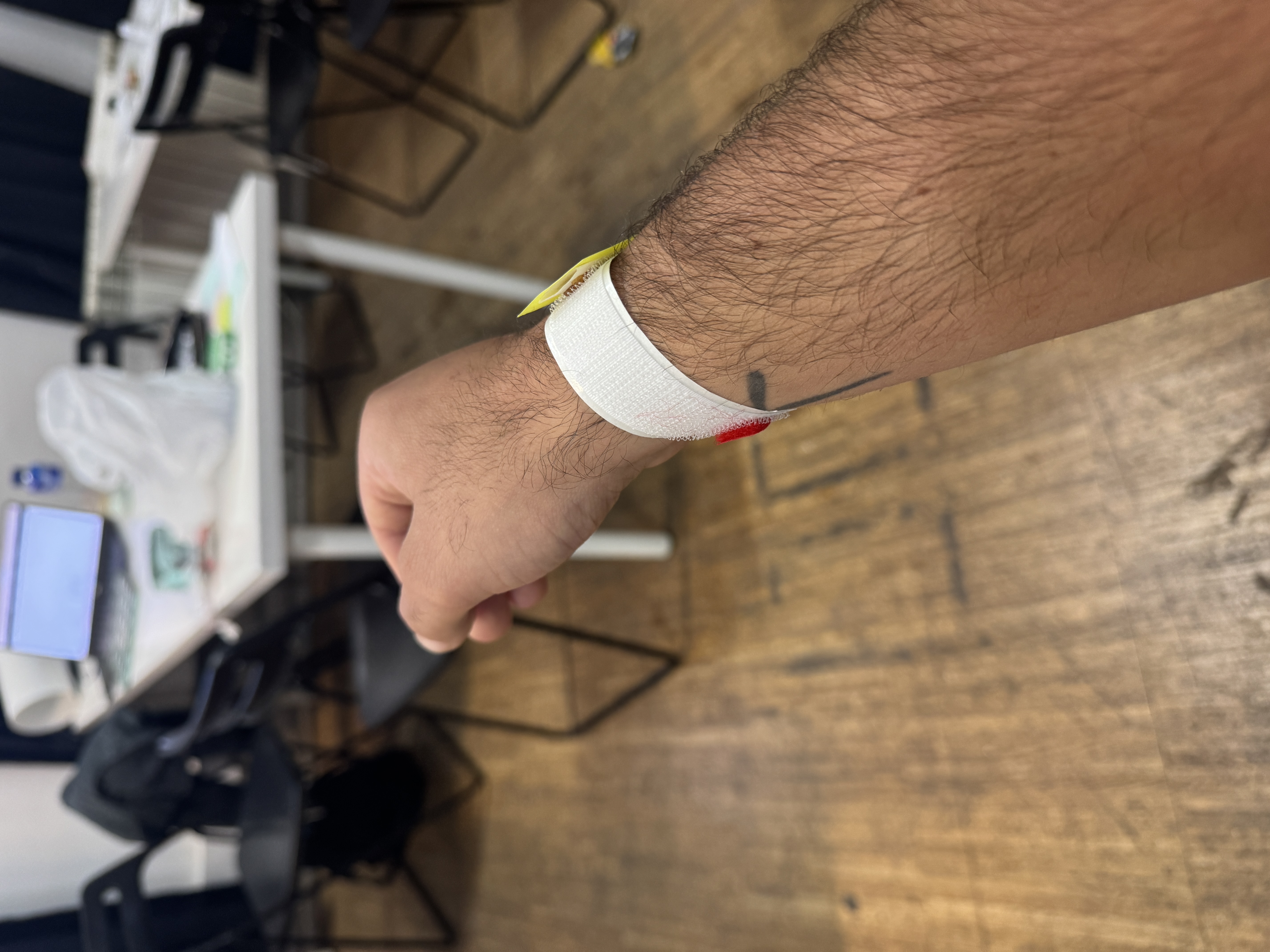 Solarlink Prosthesis - Side View 1